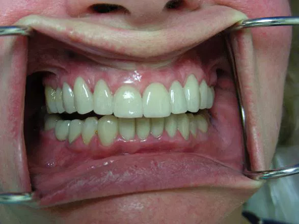 Invisalign after