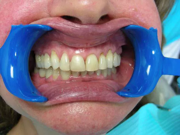 Invisalign before