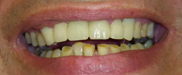 Invisalign after