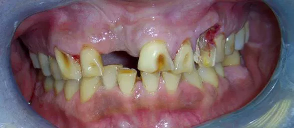 Invisalign before