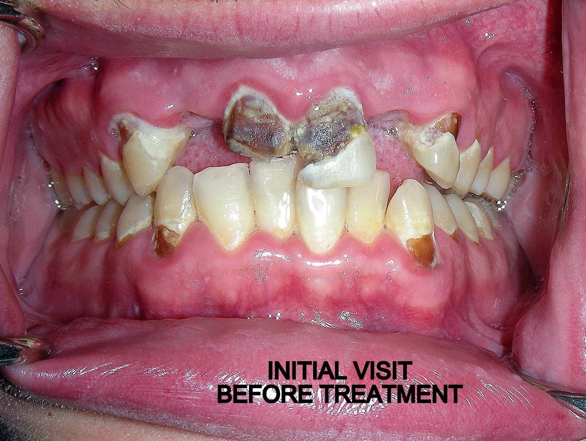 Cosmetic Bridge before