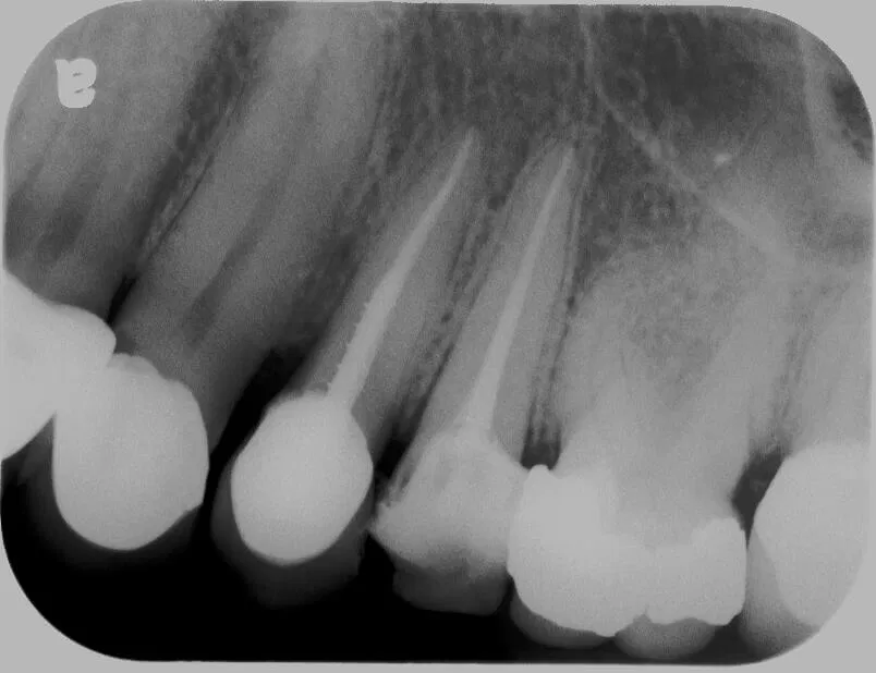 Root Canal after