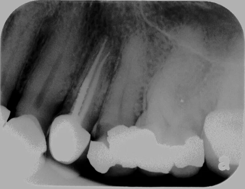 Root Canal before