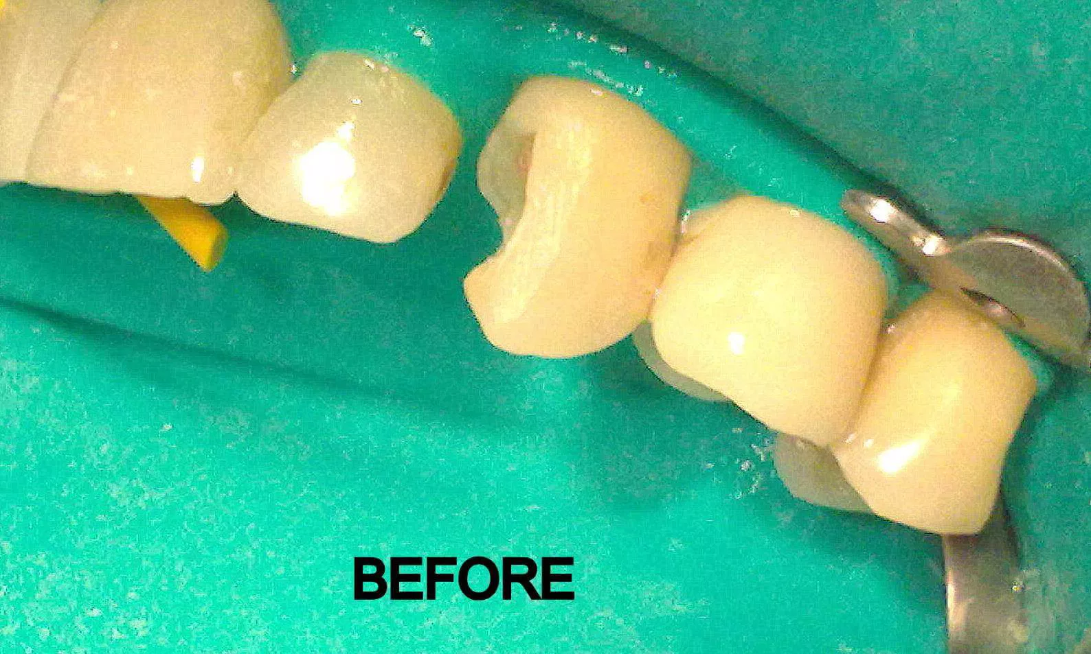 Cosmetic Filling before