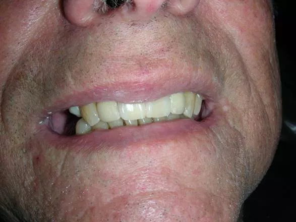 Cosmetic Filling after