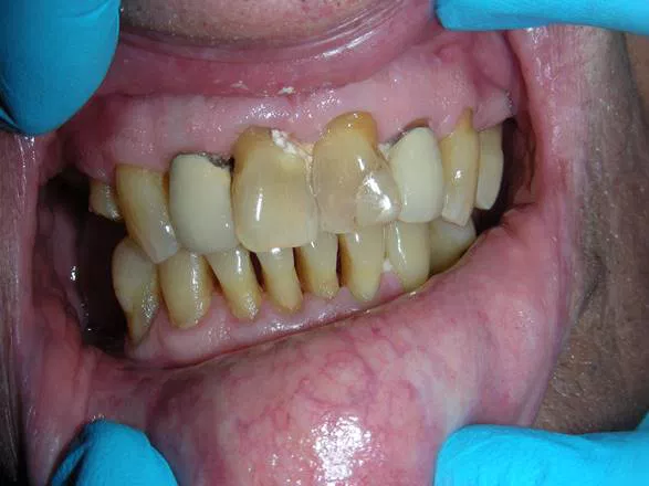 Cosmetic Filling before