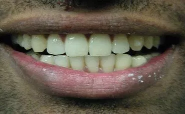 Invisalign after