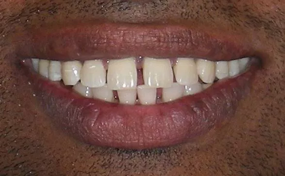 Invisalign before
