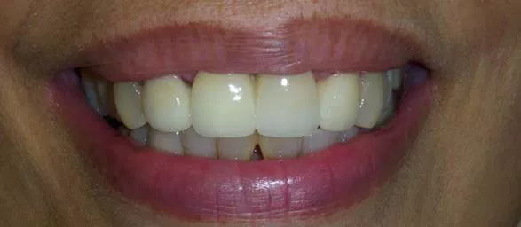 Invisalign after