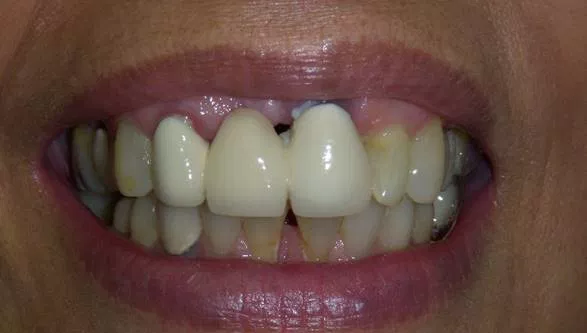 Invisalign before