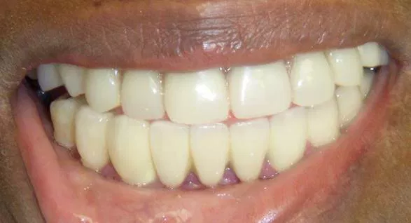 Invisalign after