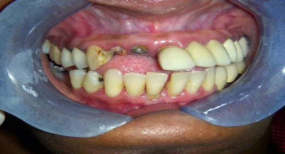 Invisalign before