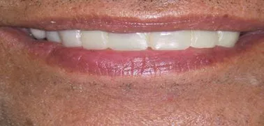 Invisalign after