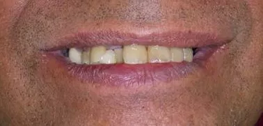 Invisalign before