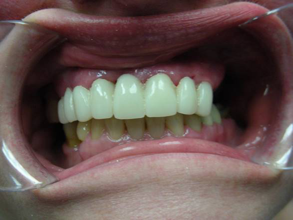 Invisalign after