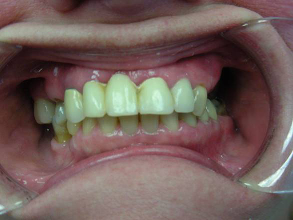 Invisalign before