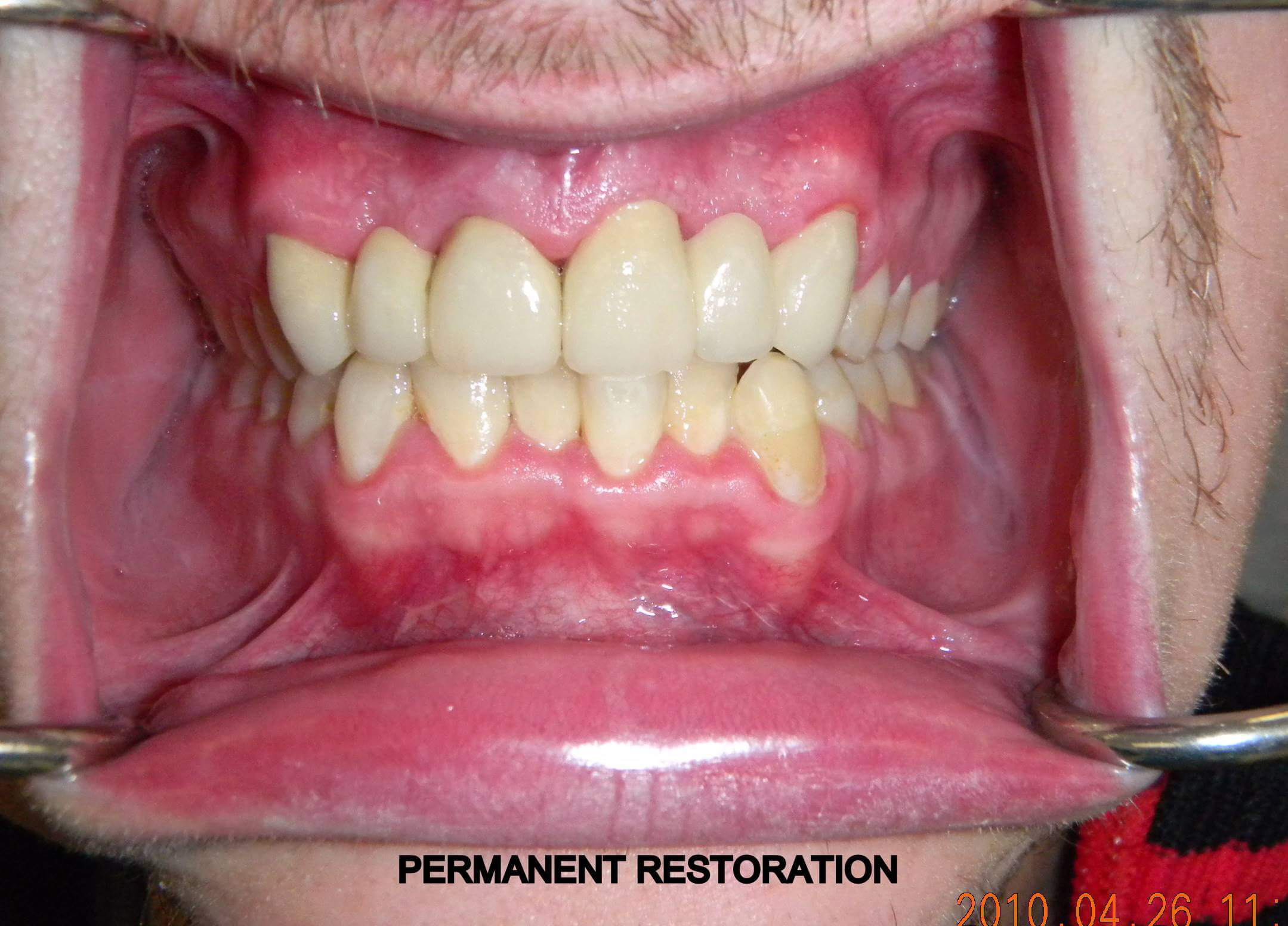 Cosmetic Bridge after