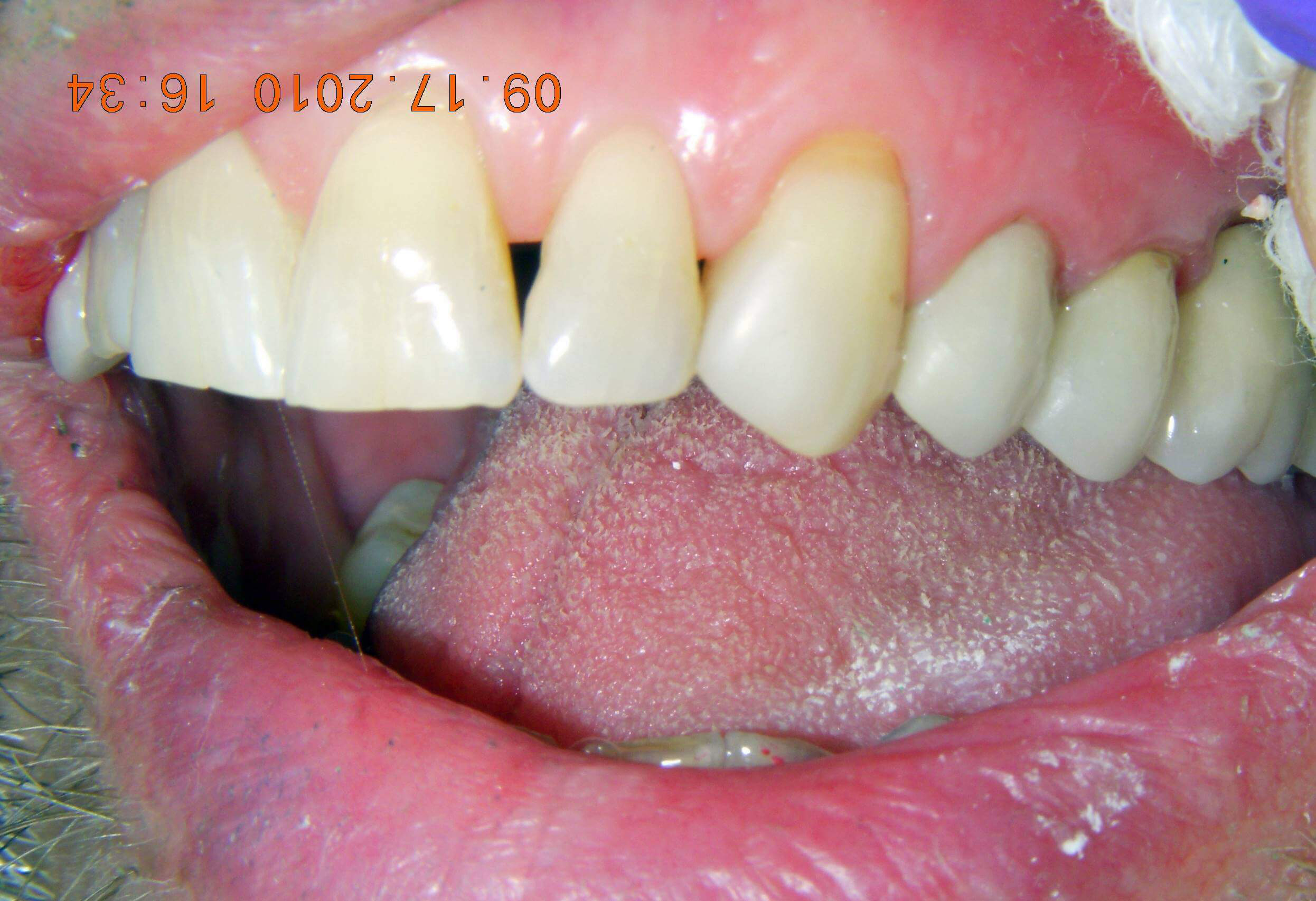 Cosmetic Filling after
