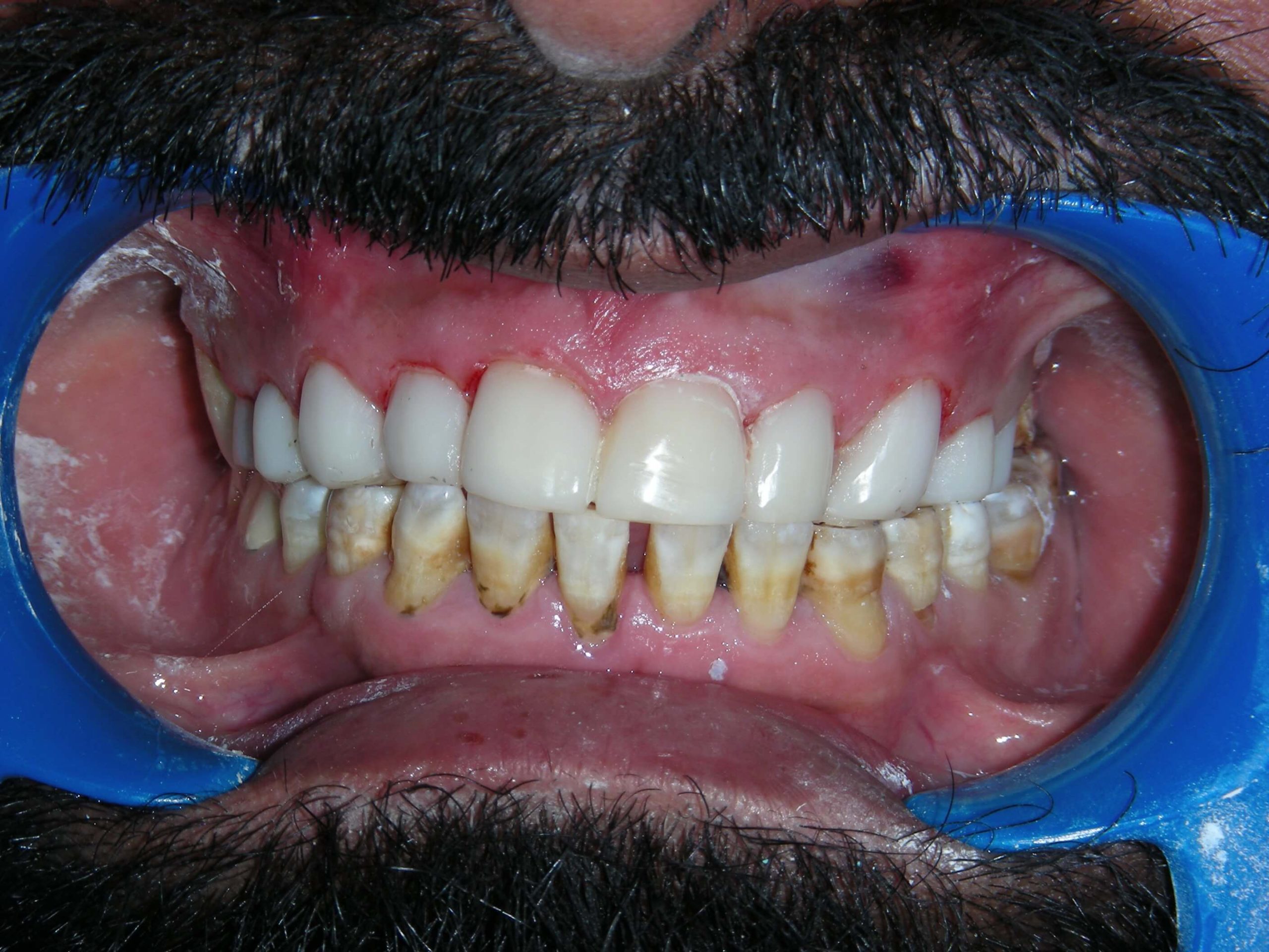 Invisalign after