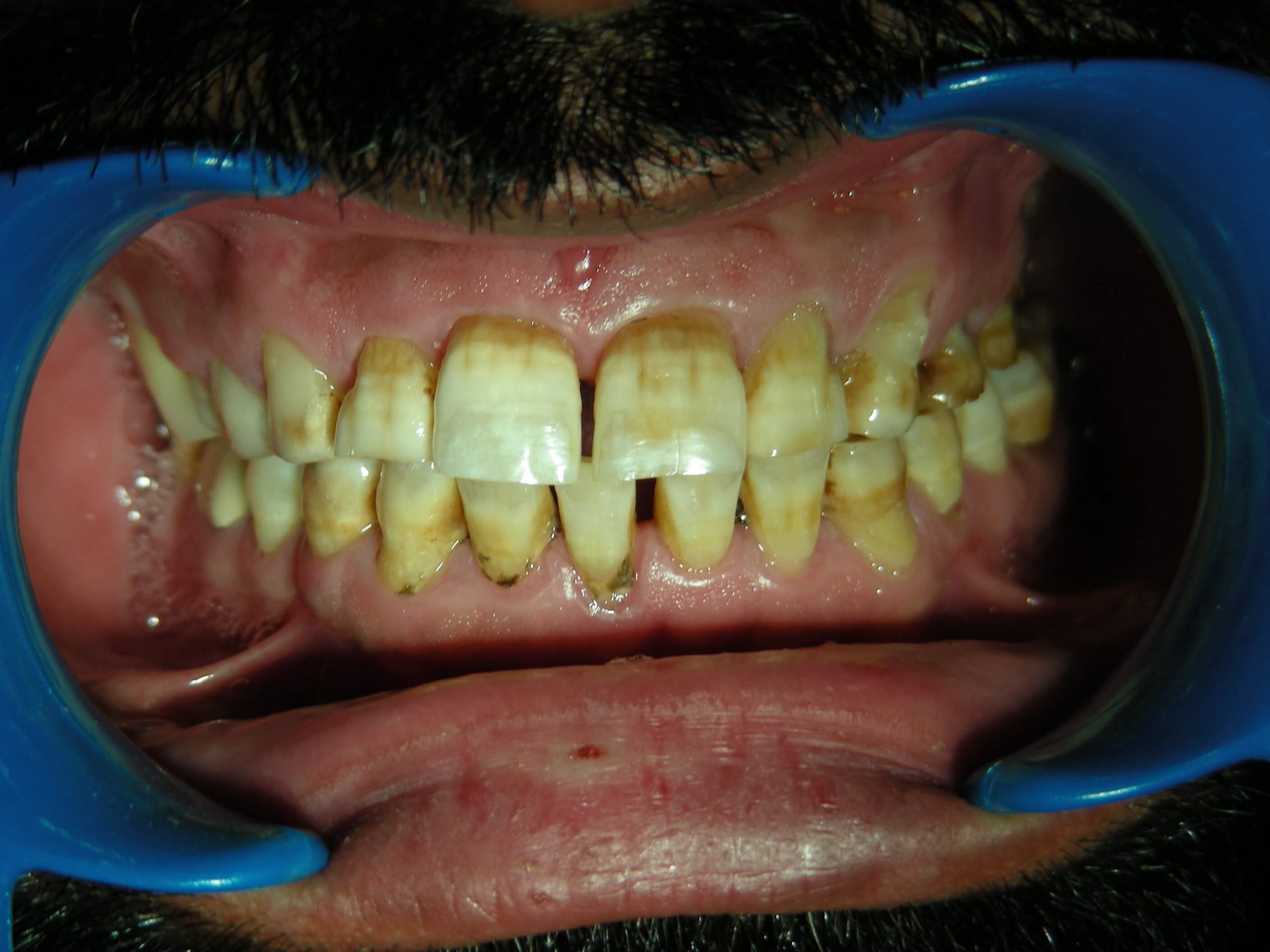 Invisalign before